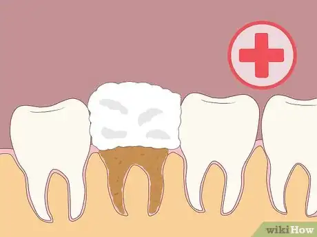 Imagen titulada Prevent Dry Socket After a Tooth Extraction Step 10