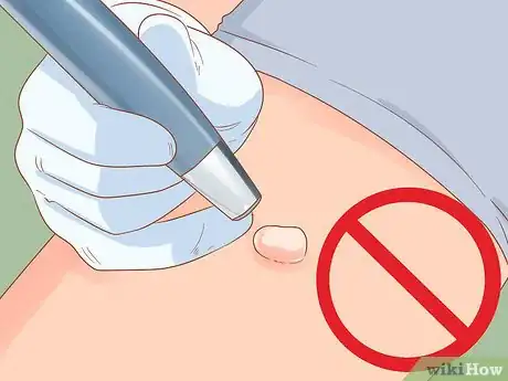 Imagen titulada Stop a Keloid from Growing Step 10