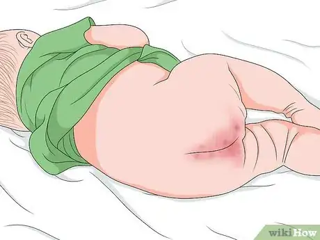 Imagen titulada Relieve Diaper Rash Fast Step 7