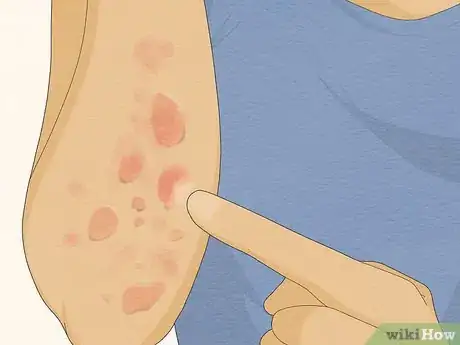 Imagen titulada Recognize Hives (Rash) Step 3