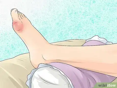 Imagen titulada Get Gout Relief at Home Step 1