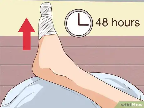 Imagen titulada Treat a Torn Toenail Step 8