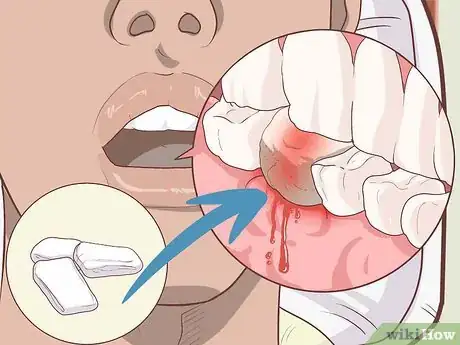 Imagen titulada Prepare for Tooth Extraction Step 11