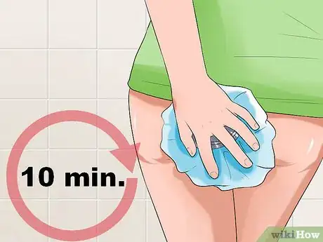 Imagen titulada Stop Hemorrhoids from Itching Step 5