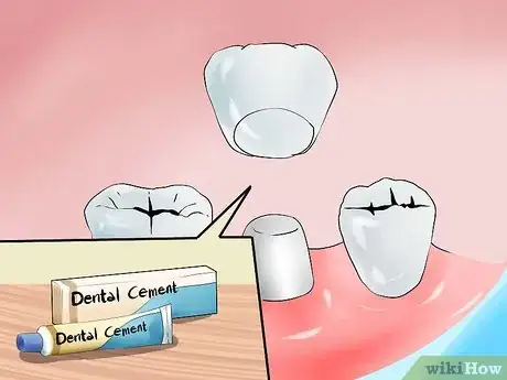 Imagen titulada Avoid Dental Crown Problems Step 3