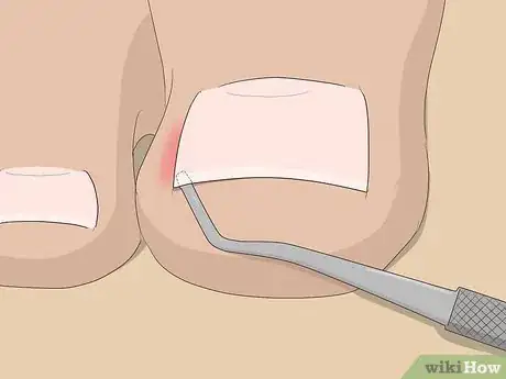 Imagen titulada Relieve Ingrown Toe Nail Pain Step 15