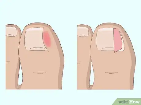 Imagen titulada Relieve Ingrown Toe Nail Pain Step 25