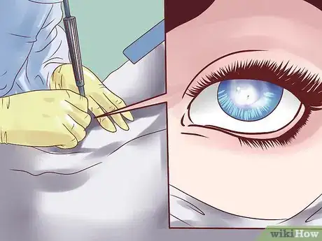 Imagen titulada Lower Eye Pressure Without Drops Step 7