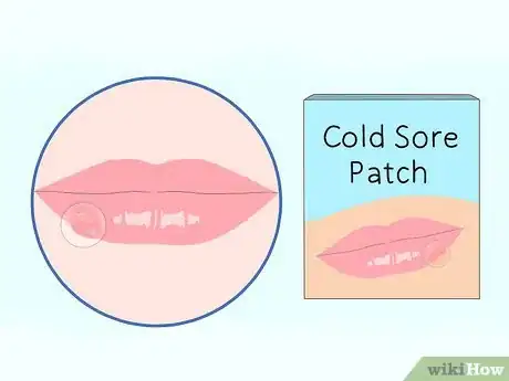 Imagen titulada Get Rid of Mouth Blisters Step 4