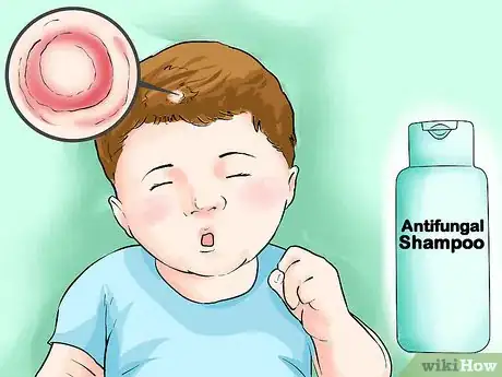 Imagen titulada Treat Ringworm in Babies Step 5