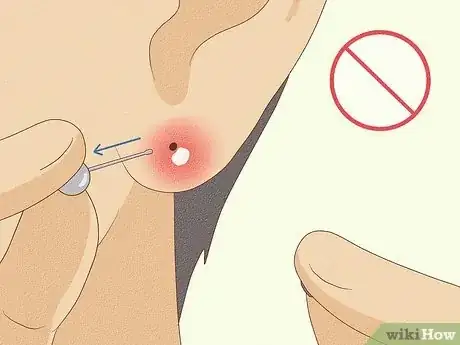 Imagen titulada Treat Infected Piercings Step 14