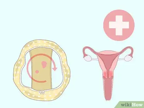 Imagen titulada Identify Abnormal Vaginal Spotting Between Periods Step 12