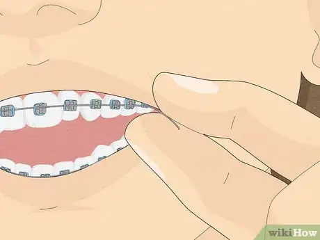 Imagen titulada Temporarily Fix a Loose Wire on Your Braces Step 10