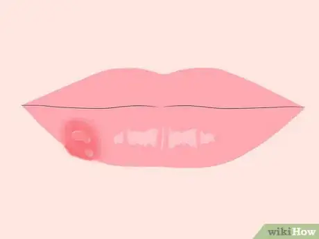 Imagen titulada Get Rid of Mouth Blisters Step 1