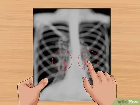 Imagen titulada Read a Chest X Ray Step 20