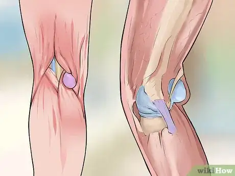 Imagen titulada Cure a Baker's Cyst Step 1