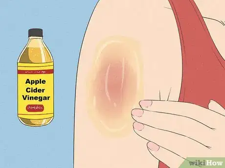 Imagen titulada Cope with Itchy Skin During Menopause Step 16