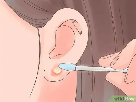 Imagen titulada Treat an Infected Ear Piercing Step 8