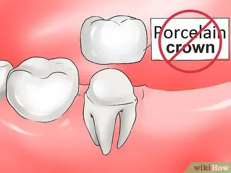 Imagen titulada Avoid Dental Crown Problems Step 4