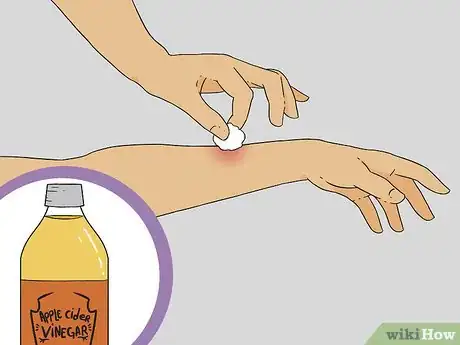 Imagen titulada Treat a Bee Sting Step 10