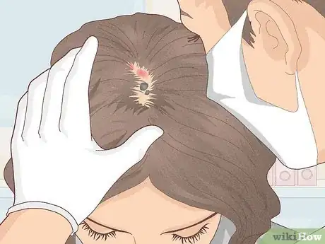 Imagen titulada Bumps on Scalp Step 18