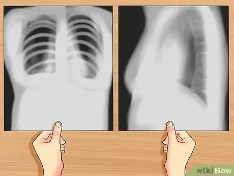Imagen titulada Read a Chest X Ray Step 8