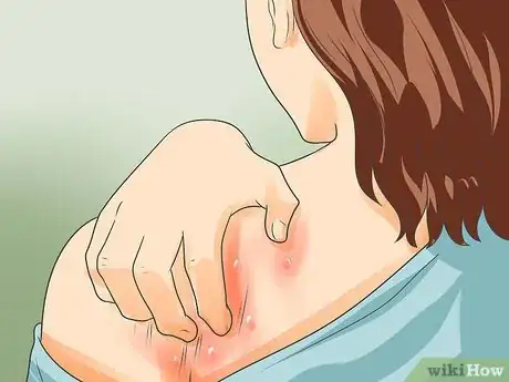 Imagen titulada Recognize Scabies Rash Step 1