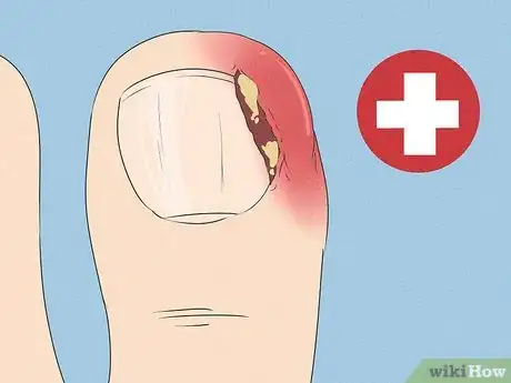 Imagen titulada Will an Ingrown Toenail Heal Itself Step 2