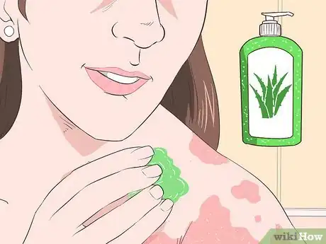 Imagen titulada Get Rid of Sunburn Fast Step 3