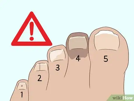 Imagen titulada Treat a Black Toenail Step 14