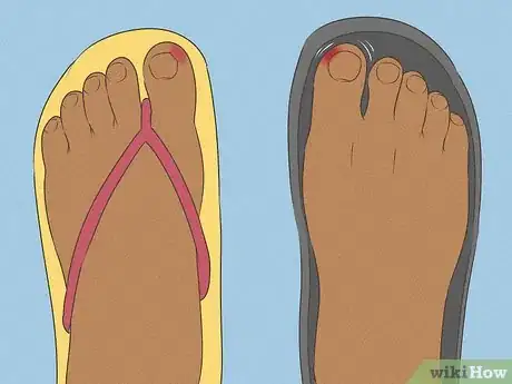 Imagen titulada Will an Ingrown Toenail Heal Itself Step 5