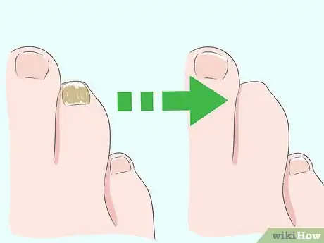 Imagen titulada Treat a Black Toenail Step 13