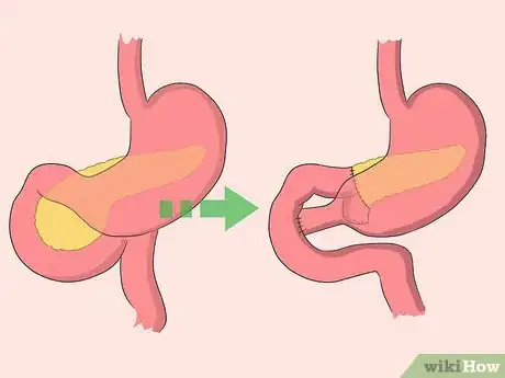 Imagen titulada Keep Your Pancreas Healthy Step 16