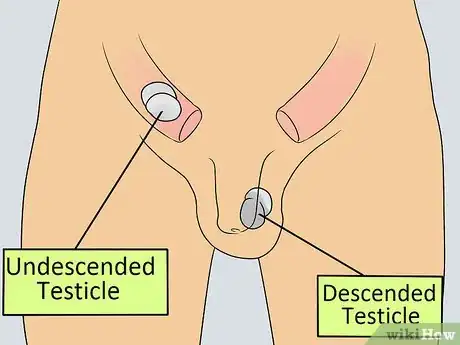 Imagen titulada Recognize Male Infertility Step 14