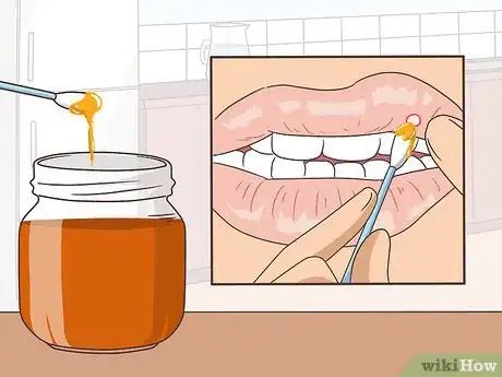 Imagen titulada Remove a Mouth Ulcer Step 6