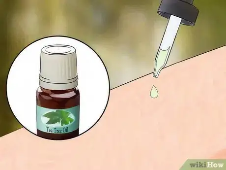 Imagen titulada Get Rid of Bug Bites Step 11