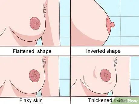 Imagen titulada Treat Breast and Extramammary Paget's Disease Step 11