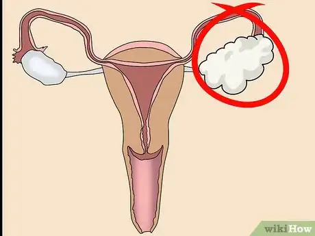 Imagen titulada Know if You Have an Ovarian Cyst Step 11