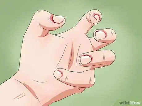 Imagen titulada Stop Biting Your Fingers Step 11