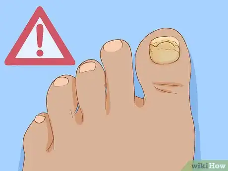 Imagen titulada Help a Toenail Grow Back Quickly Step 15