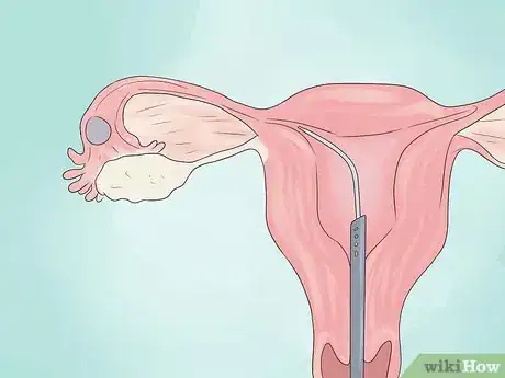 Imagen titulada Treat Blocked Fallopian Tubes Step 17