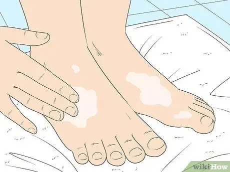 Imagen titulada Treat Cellulitis Step 14