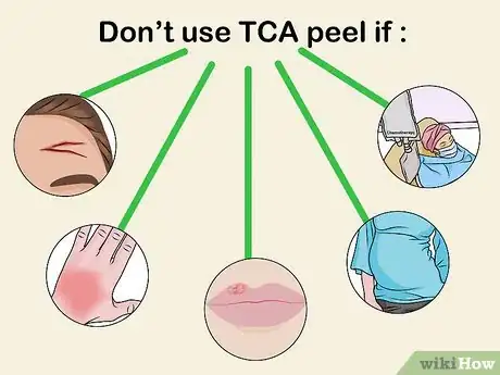 Imagen titulada Apply a TCA Peel Step 1