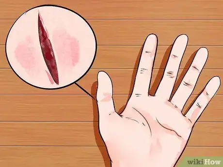 Imagen titulada Treat a Finger Hit by a Hammer Step 4