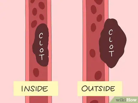 Imagen titulada Dissolve Blood Clots Step 3