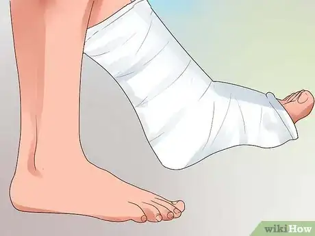 Imagen titulada Heal a Broken Toe Step 10