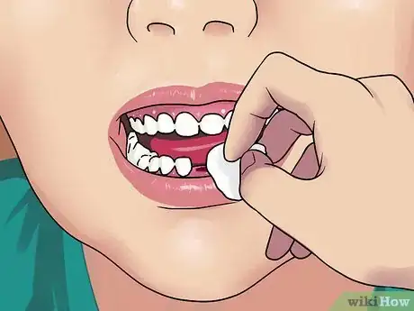 Imagen titulada Stop the Bleeding After You Pull out a Loose Tooth Step 3