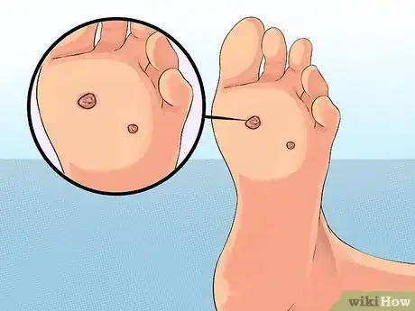 Imagen titulada Get Rid of Plantar Warts (Verrucas) Step 13