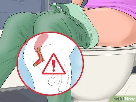 Imagen titulada Tell if You Have Internal Hemorrhoids Step 1