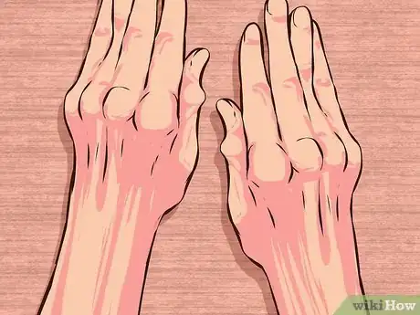 Imagen titulada Use Aloe Vera to Treat Rheumatoid Arthritis Step 14